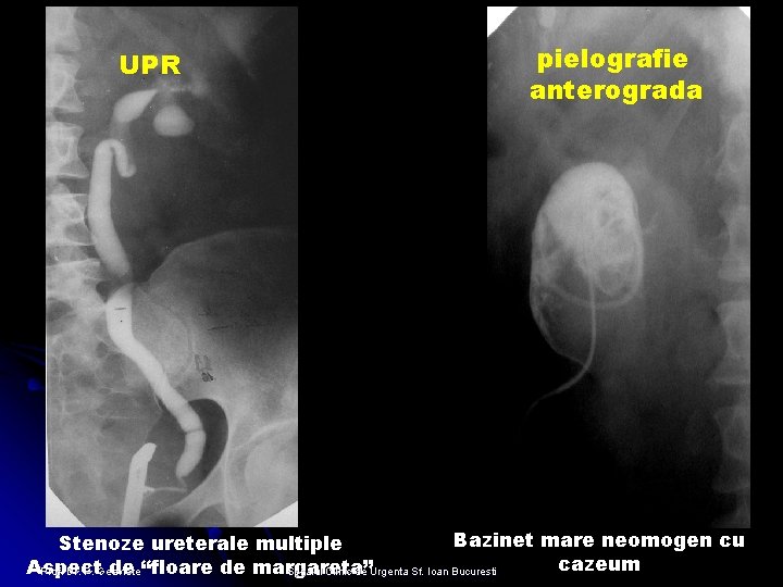 UPR pielografie anterograda Bazinet mare neomogen cu Stenoze ureterale multiple cazeum Aspect de “floare