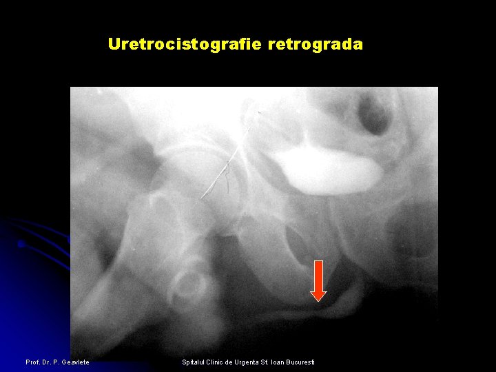 Uretrocistografie retrograda Prof. Dr. P. Geavlete Spitalul Clinic de Urgenta Sf. Ioan Bucuresti 