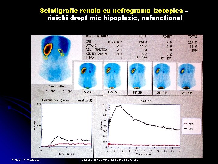 Scintigrafie renala cu nefrograma izotopica – rinichi drept mic hipoplazic, nefunctional Prof. Dr. P.