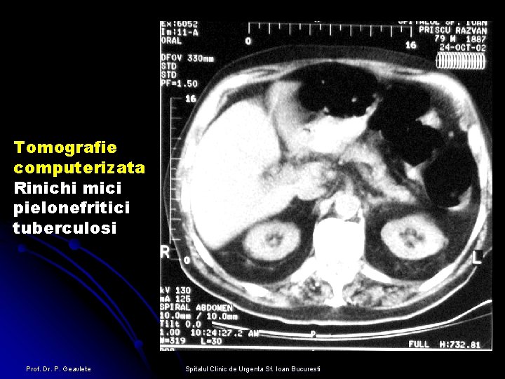 Tomografie computerizata Rinichi mici pielonefritici tuberculosi Prof. Dr. P. Geavlete Spitalul Clinic de Urgenta