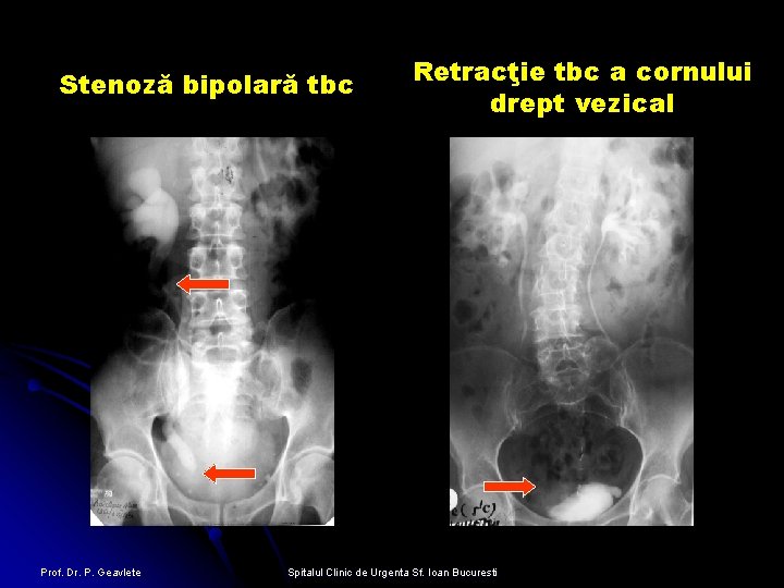 Stenoză bipolară tbc Prof. Dr. P. Geavlete Retracţie tbc a cornului drept vezical Spitalul