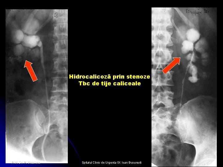 Hidrocalicoză prin stenoze Tbc de tije caliceale Prof. Dr. P. Geavlete Spitalul Clinic de