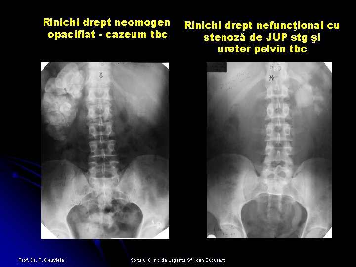 Rinichi drept neomogen opacifiat - cazeum tbc Prof. Dr. P. Geavlete Rinichi drept nefuncţional