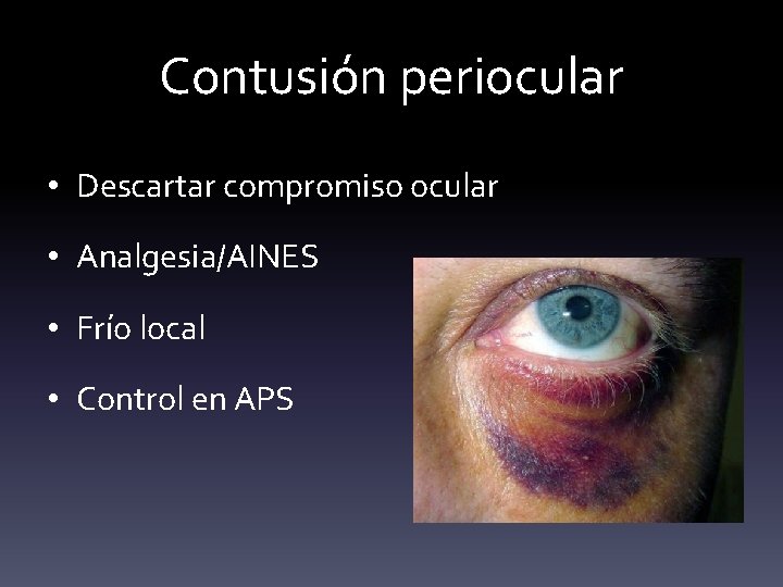 Contusión periocular • Descartar compromiso ocular • Analgesia/AINES • Frío local • Control en