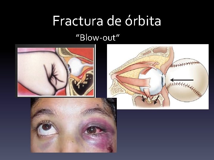 Fractura de órbita ”Blow-out” 