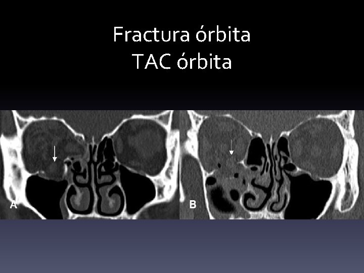 Fractura órbita TAC órbita 