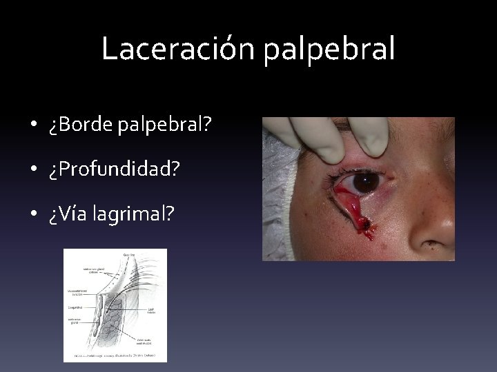 Laceración palpebral • ¿Borde palpebral? • ¿Profundidad? • ¿Vía lagrimal? 