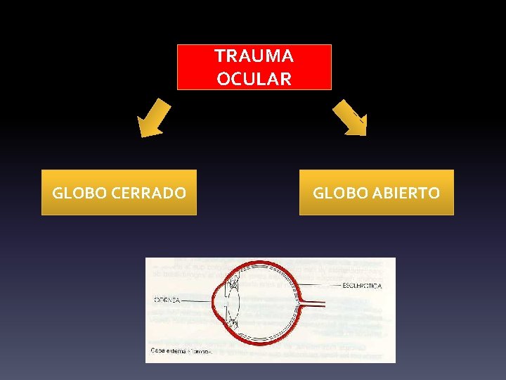 TRAUMA OCULAR GLOBO CERRADO GLOBO ABIERTO 