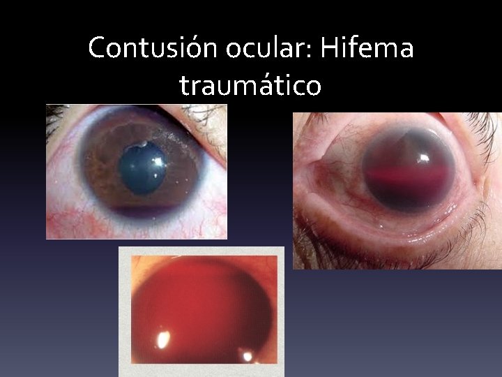 Contusión ocular: Hifema traumático 