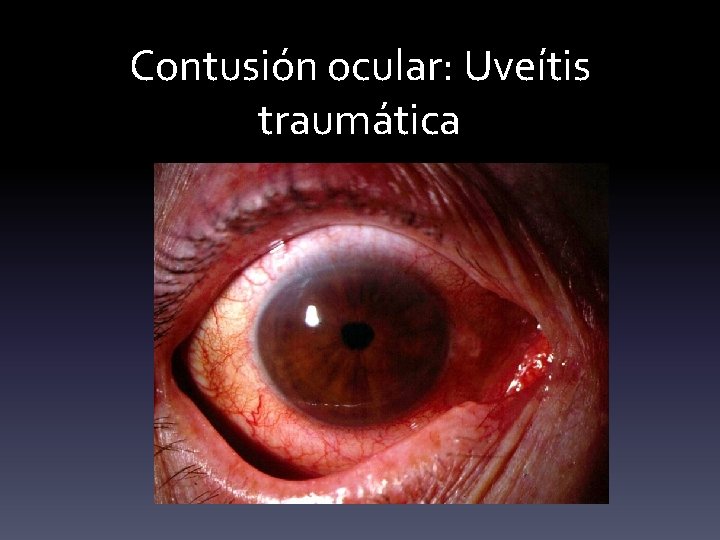 Contusión ocular: Uveítis traumática 