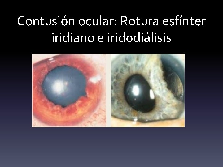 Contusión ocular: Rotura esfínter iridiano e iridodiálisis 