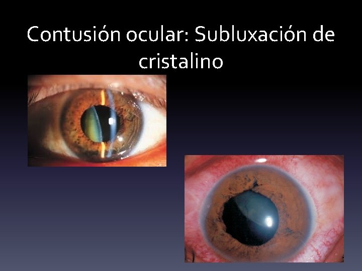 Contusión ocular: Subluxación de cristalino 