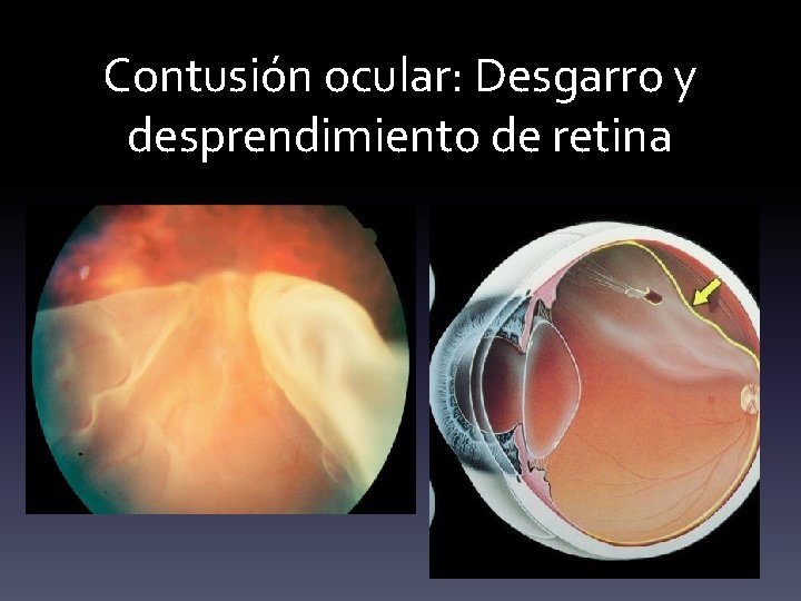 Contusión ocular: Desgarro y desprendimiento de retina 