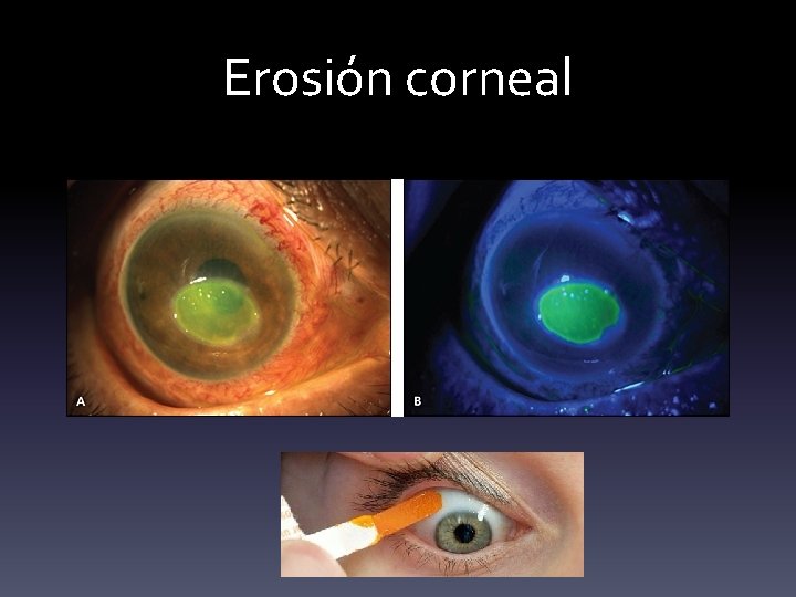 Erosión corneal 
