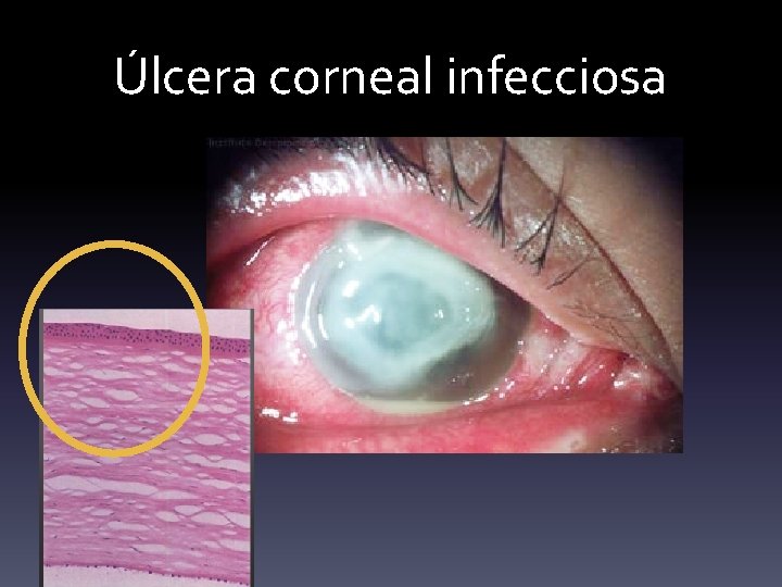 Úlcera corneal infecciosa 