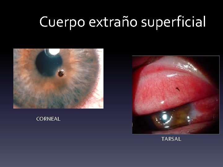 Cuerpo extraño superficial CORNEAL TARSAL 