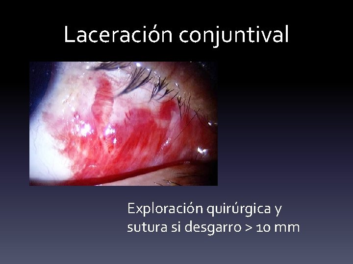 Laceración conjuntival Exploración quirúrgica y sutura si desgarro > 10 mm 