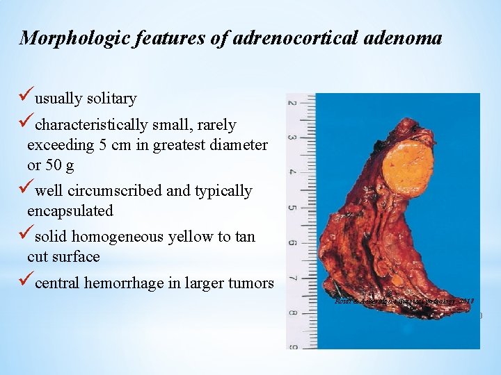 Morphologic features of adrenocortical adenoma üusually solitary ücharacteristically small, rarely exceeding 5 cm in