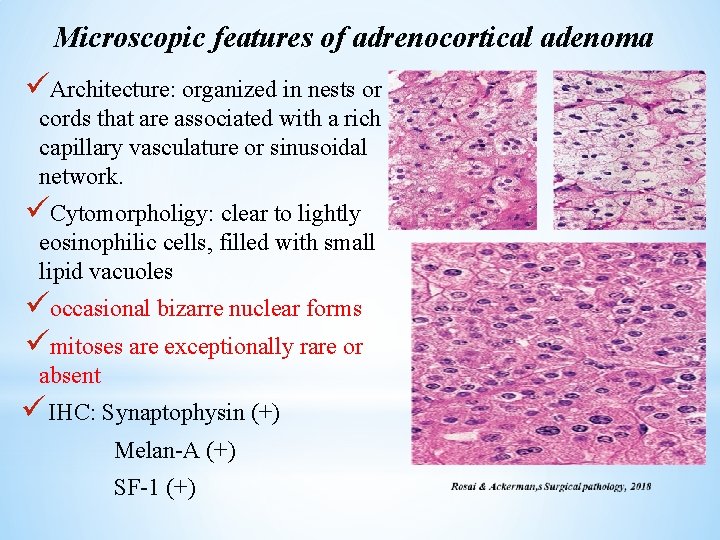 Microscopic features of adrenocortical adenoma üArchitecture: organized in nests or cords that are associated