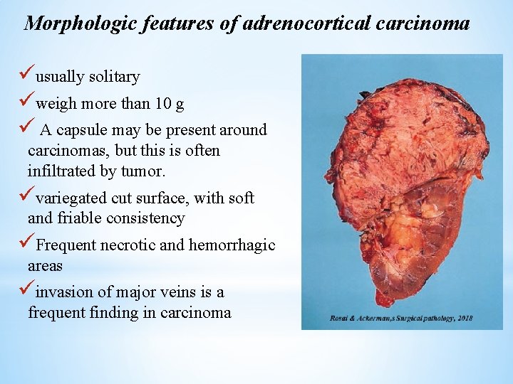 Morphologic features of adrenocortical carcinoma üusually solitary üweigh more than 10 g ü A