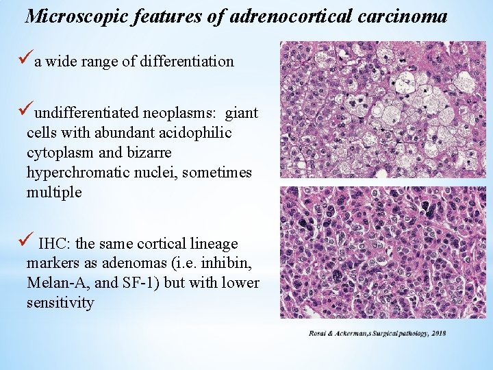 Microscopic features of adrenocortical carcinoma üa wide range of differentiation üundifferentiated neoplasms: giant cells
