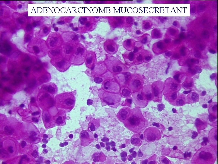 ADENOCARCINOME MUCOSECRETANT 