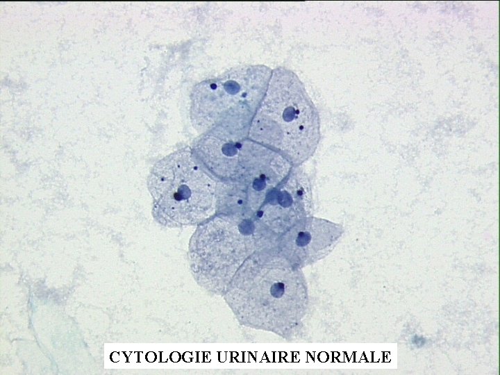 CYTOLOGIE URINAIRE NORMALE 