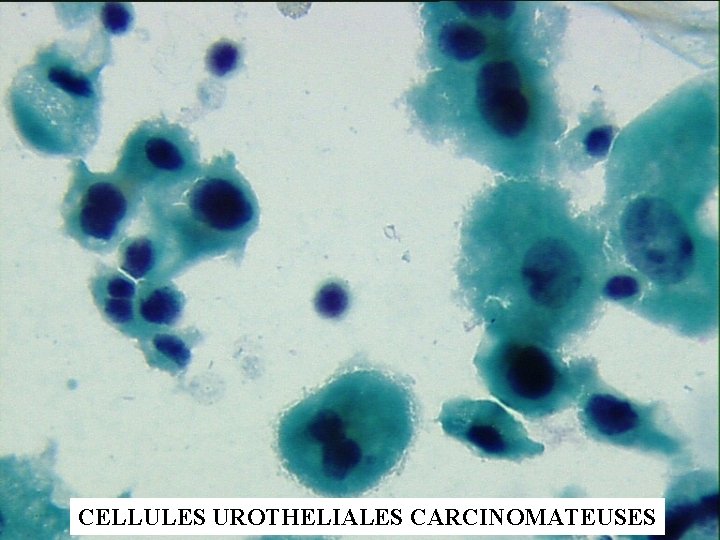 CELLULES UROTHELIALES CARCINOMATEUSES 