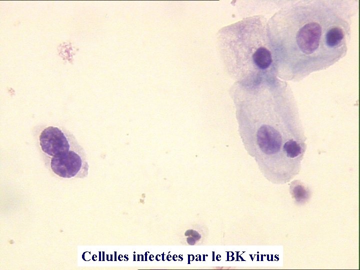 Cellules infectées par le BK virus 