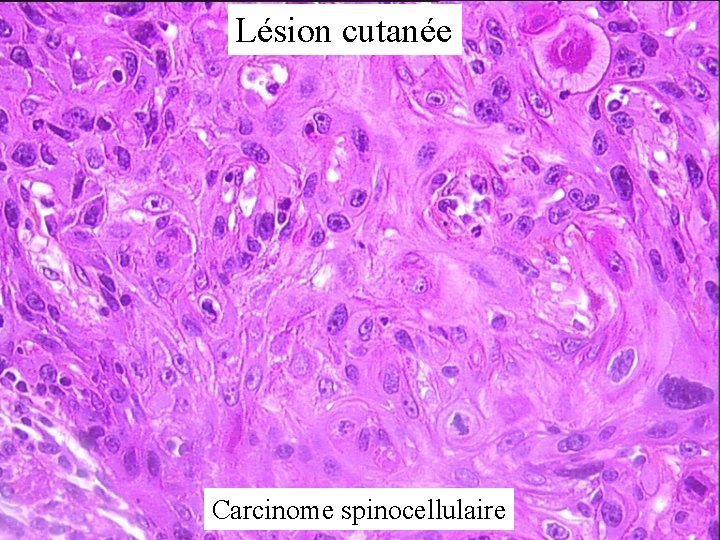 Lésion cutanée Carcinome spinocellulaire 