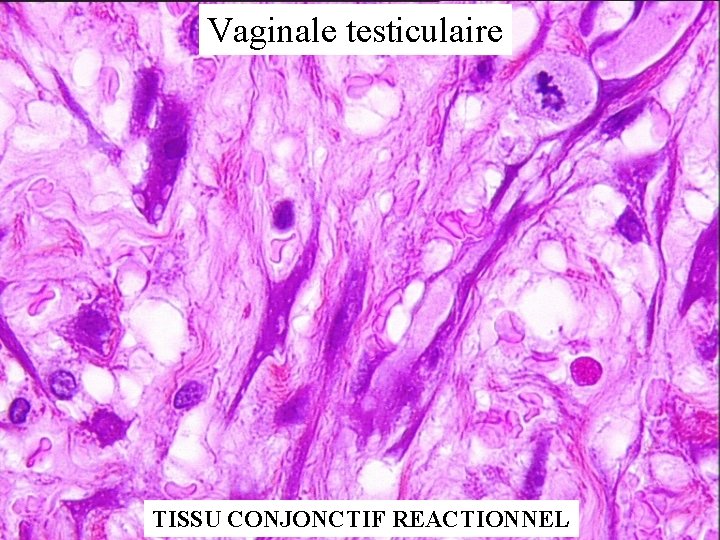 Vaginale testiculaire TISSU CONJONCTIF REACTIONNEL 
