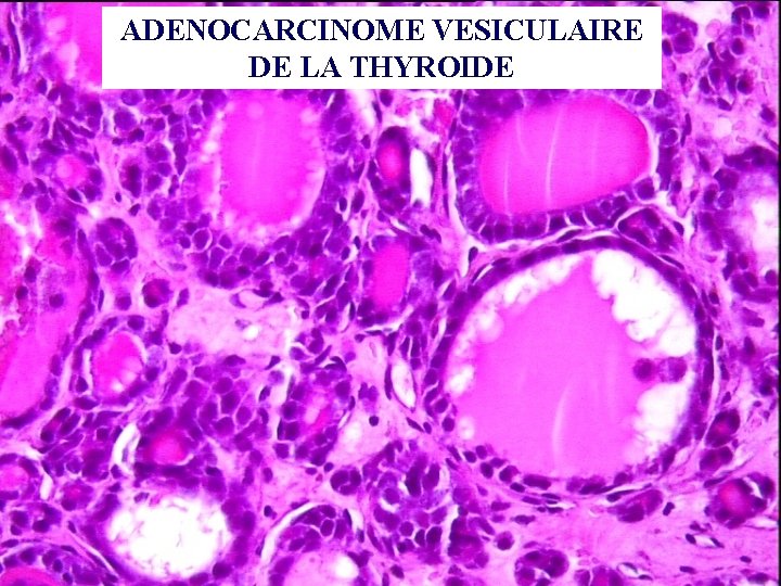 ADENOCARCINOME VESICULAIRE DE LA THYROIDE 