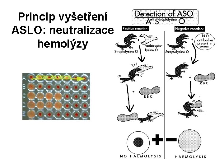 Princip vyšetření ASLO: neutralizace hemolýzy 