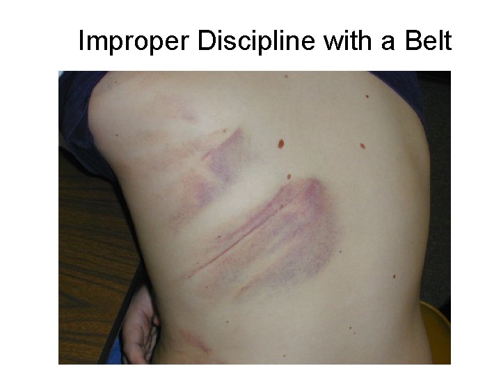 Improper Discipline with a Belt 