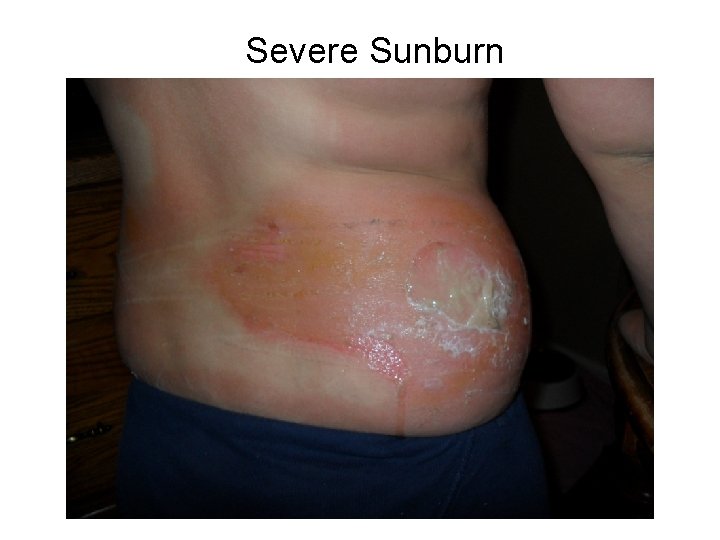Severe Sunburn 