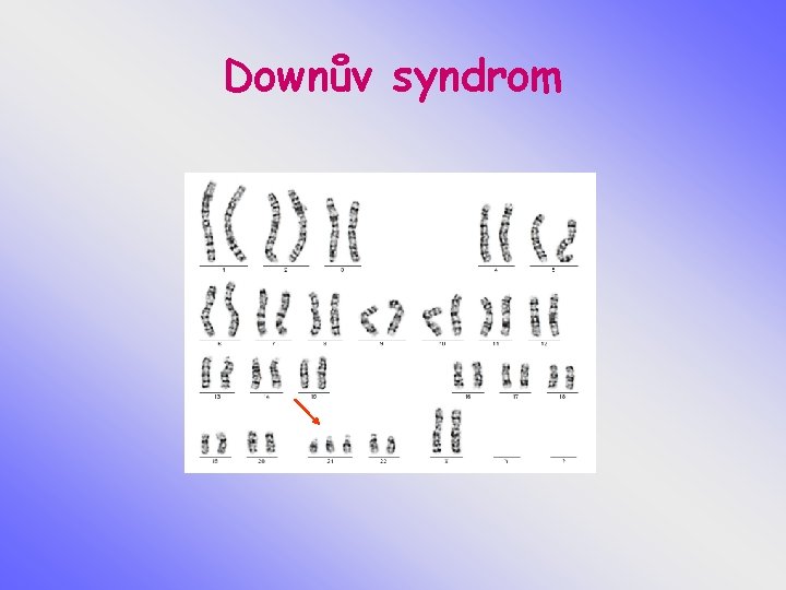 Downův syndrom 