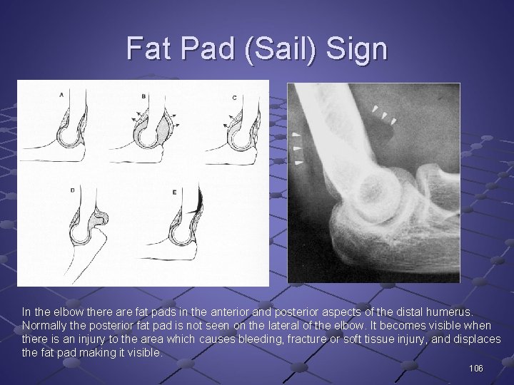 Fat Pad (Sail) Sign In the elbow there are fat pads in the anterior