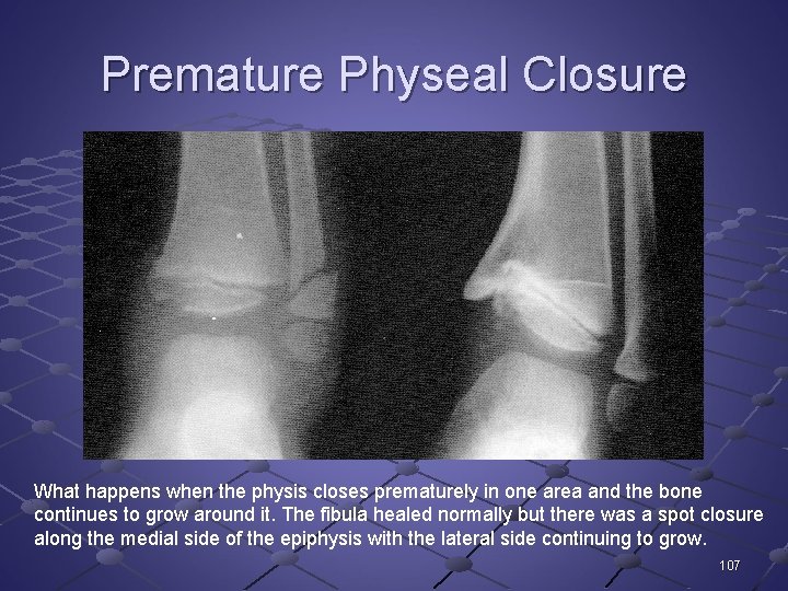 Premature Physeal Closure What happens when the physis closes prematurely in one area and