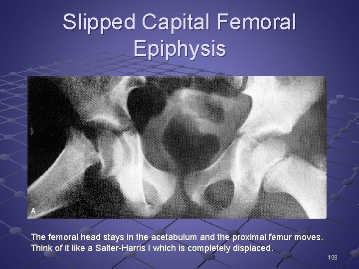 Slipped Capital Femoral Epiphysis The femoral head stays in the acetabulum and the proximal