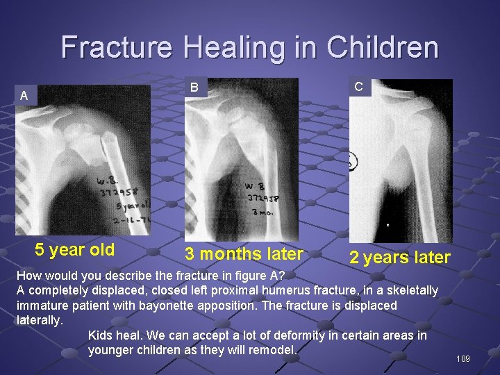 Fracture Healing in Children B A 5 year old 3 months later C 2