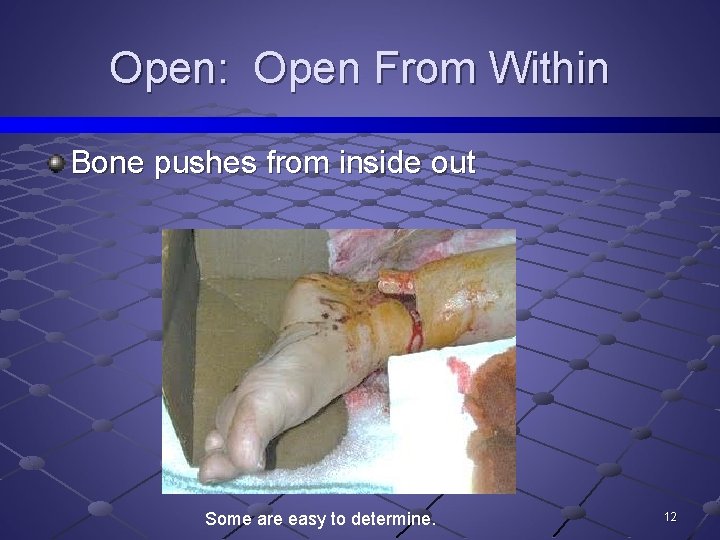 Open: Open From Within Bone pushes from inside out Some are easy to determine.