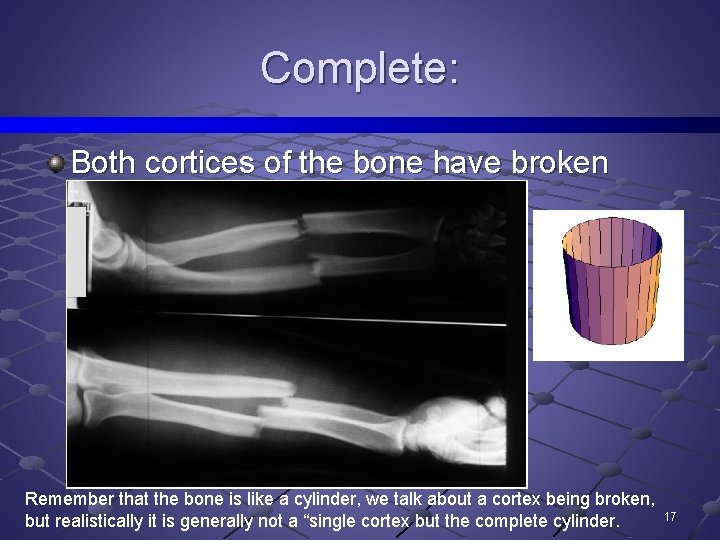 Complete: Both cortices of the bone have broken Remember that the bone is like