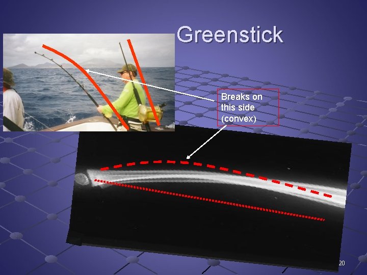 Greenstick Breaks on this side (convex) 20 