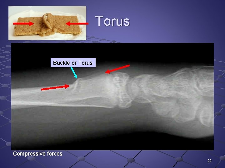 Torus Buckle or Torus Compressive forces 22 