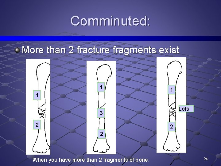 Comminuted: More than 2 fracture fragments exist 1 1 1 Lots 3 2 2