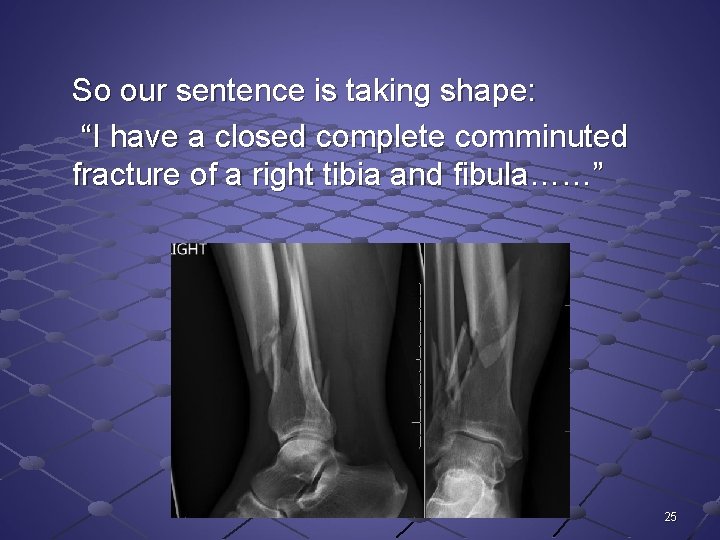 So our sentence is taking shape: “I have a closed complete comminuted fracture of