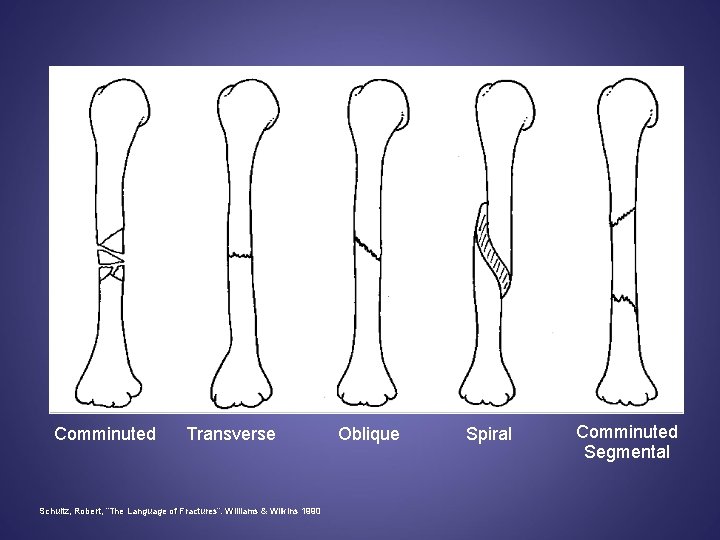 Comminuted Transverse Schultz, Robert, “The Language of Fractures”. Williams & Wilkins 1990 Oblique Spiral