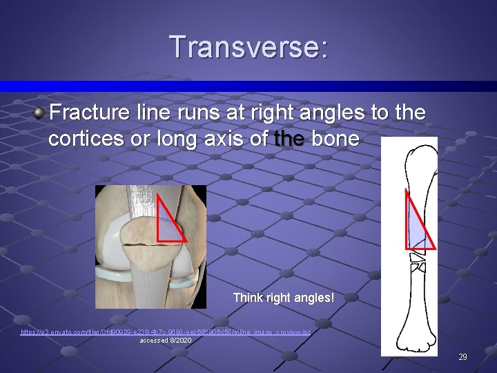 Transverse: Fracture line runs at right angles to the cortices or long axis of