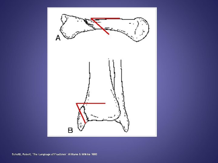 Schultz, Robert, “The Language of Fractures”. Williams & Wilkins 1990 