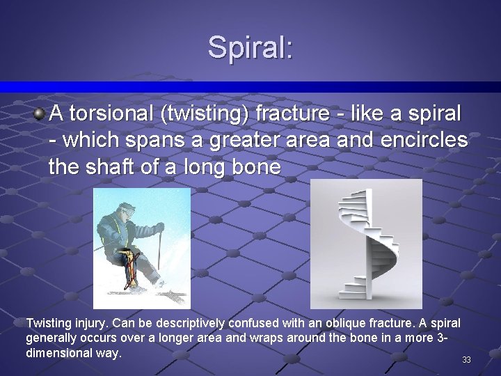 Spiral: A torsional (twisting) fracture - like a spiral - which spans a greater